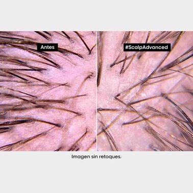 Champú Anti-Malestar Scalp Advanced - L' Oreal Professionnel