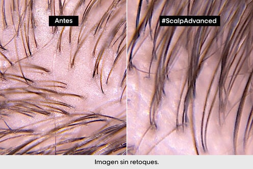 Champú Anti-Grasa Scalp Advanced - L' Oreal Professionnel