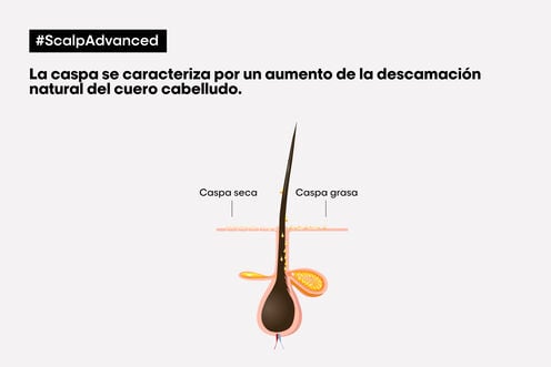 Champú Anticaspa - L' Oreal Professionnel