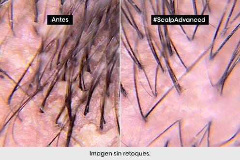 Champú Anticaspa - L' Oreal Professionnel